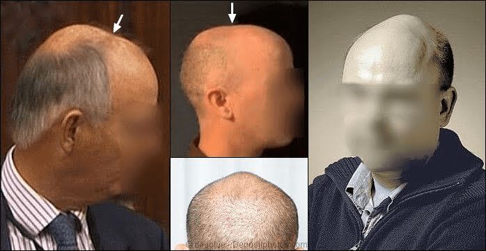extreme-skull-expansion-and-hair-loss.jpg